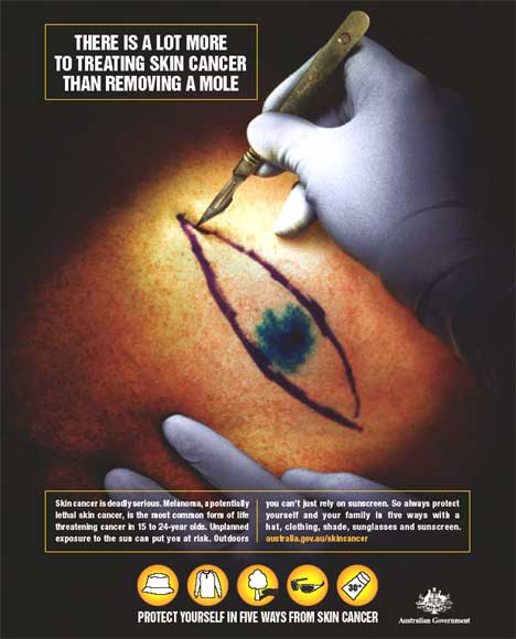 Removal of Melanoma - poster in Australian skin cancer awareness campaign